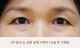 CDI 중년 눈 성형 실제 사례자 (수술 후 3개월)