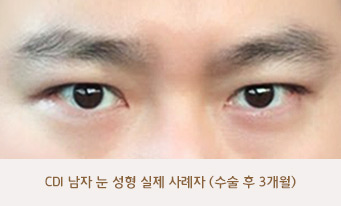 CDI 남자 눈 성형 실제 사례자 (수술 후 3개월)