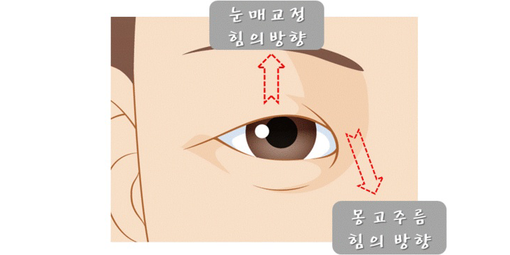 눈매교정과 앞트임 수술법