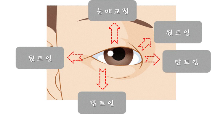 눈매교정과 멀티트임 수술법