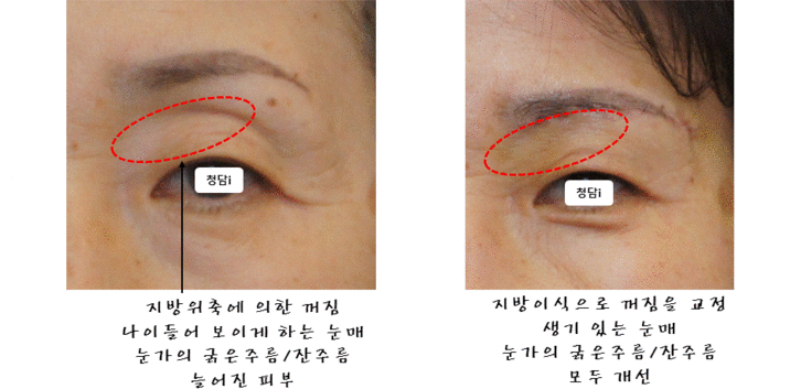 revision-blepharoplasty-sunken-eyelid-2