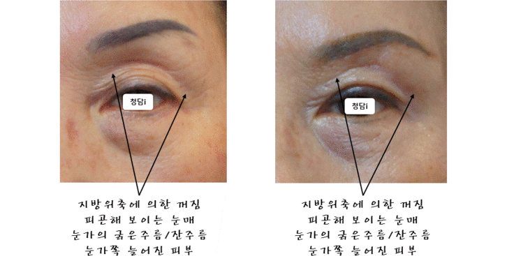 revision-blepharoplasty-sunken-eyelid-3
