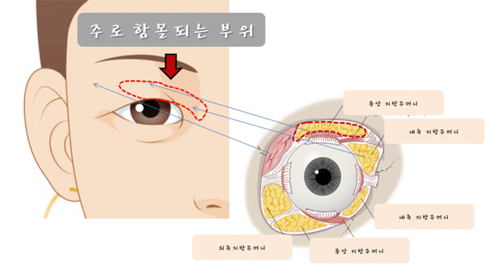 revision-blepharoplasty-sunken-eyelid