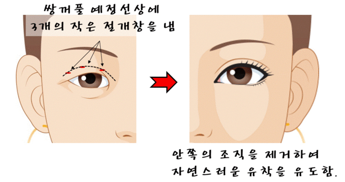 double_eyelid_surgery